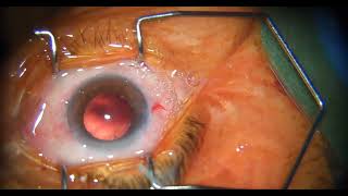 Phaco surgery for grade 2 cataract cataractsurgery cataract cataractsurgeon ophthalmology [upl. by Godwin]