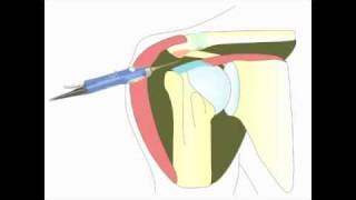 Acromioplastie arthroscopique de lépaule pour tendinite [upl. by Andriana502]