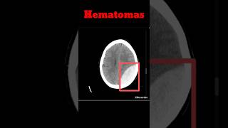 Brain Hematoma CT Brain  EDH  SDH shorts hematoma radiology brainhaemorrhage [upl. by Alemap]