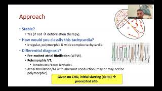 WPW syndrome amp SVT management [upl. by Abeu787]