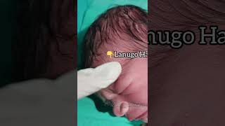 Are these Lanugo Hair of newborn [upl. by Cattima351]