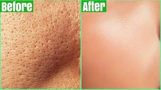 How To Get Rid Of LARGE PORES PERMANENTLY 100 Works Shrink amp Get Clear Glass Skin Naturally [upl. by Anyzratak]