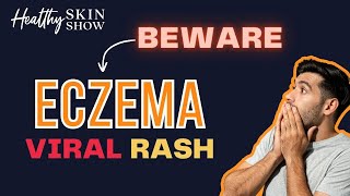 VIRAL Skin INFECTION Signs aka Eczema Herpeticum 😱  Dr Peter Lio [upl. by Elokcin]