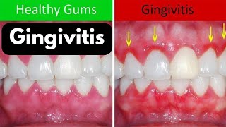 Gingivitis treatment at home  Gingivitis symptoms and cure  bleeding gums [upl. by Kessler335]