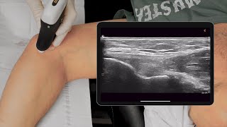 Medial Elbow PRP Injection [upl. by Akihsal]