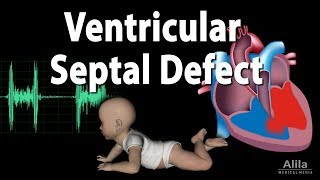 Ventricular Septal Defect Animation [upl. by Cired]