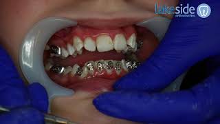 complete fitting a braces at Lakeside Orthodontics [upl. by Aztiray]