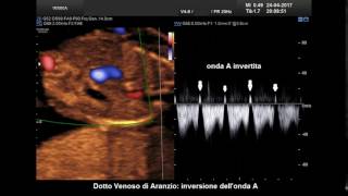 MED2000ECO Dotto Venoso di Aranzio inversione onda A [upl. by Etti]