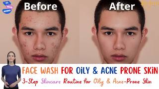 Face wash for oily and acne prone skin skincare skincareroutine acnetreatment oilyskin serum [upl. by Ykcor407]