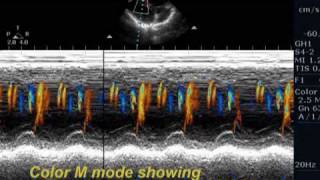 Unusual ventricular septal defect [upl. by Hgielhsa381]