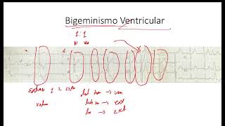 Bigeminismo y Trigeminismo  Extrasistole Auricular y Ventricular EKG [upl. by Ahsekram]