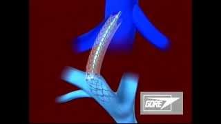 Endoprosthesis  Transjugular Intrahepatic Portosystemic Shunt TIPS [upl. by Eiramlehcar748]