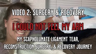 Scapholunate Ligament Tear and Reconstruction  Video 2 Surgery amp Recovery [upl. by Obau]