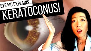 KERATOCONUS and What To Do About It  All About Cornea Crosslinking [upl. by Aleit]