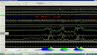 E Learning Guide dutilisation  Lecture des Polygraphies Ventilatoires [upl. by Slein]