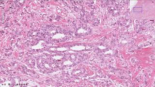 Ductal Carcinoma  Breast [upl. by Crane997]