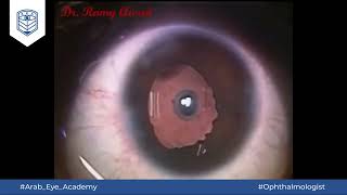 Educational Video 25 Difficult capsulorhexis in a case of Marfan syndrome by AEA [upl. by Nylaret]