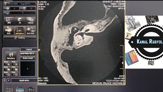 Temporal Kemik BT Nasıl Çekilir  Tomografi Nasıl Çekilir  Tomografi Zararlımı  Kanal Radyoloji [upl. by Yespmed]