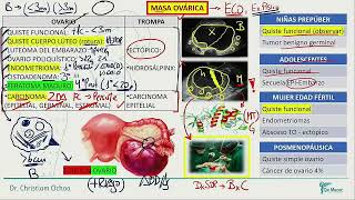 Ginecología  Masa ovarica Ca de ovario [upl. by Lamiv612]