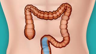 Get Relief from Constipation try a Modern Colonic Colon Hydrotherapy in Houston Texas [upl. by Nivrek]