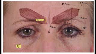 Indepth Guide To Treating The GlabellaForehead With Botox  Dr Chris Hutton [upl. by Tarfe647]