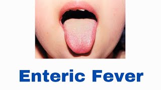 Enteric Fever  Clinical Features amp Management [upl. by Onit890]