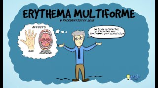 Erythema multiforme [upl. by Westerfield]