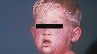 Measles cases are on the rise [upl. by Eniahpets437]