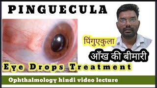 what is Pinguecula treatment  Pinguecula treatment Pinguecula treatment eye drops [upl. by Gisella111]