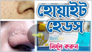 Cream Benzac uses  Whiteheads removal cream  বেনজাক ক্রিমের এর কাজ [upl. by Martel]