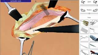 Hernia Repair  Open Surgery Simulation [upl. by Econah234]