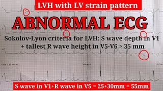 ECG Learn about STRAIN PATTERN  Very important topic [upl. by Bernelle83]