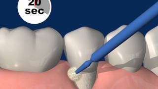 Universal adhesive Futurabond UPart 612 Treatment of hypersensitive tooth necks [upl. by Noslrac88]