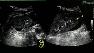 acute pyelonephritis ultrasound case [upl. by Letnwahs]