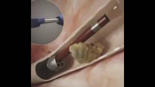 Modern methods of kidney stone removal ।। viralvideo [upl. by Deming193]