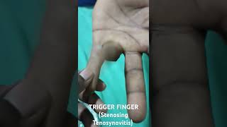 TRIGGER FINGER Stenosing Tenosynovitis flexordigitorumprofundus [upl. by Dnob]