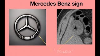 Mercedes Benz sign  Radiology spotter Medicine spotter  OSCE  MDDNBMBBS [upl. by Drolyag914]