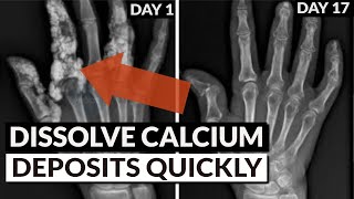 Reverse Soft Tissue Calcification Bring Calcium Out Of Tissue amp Into Bones [upl. by Avuha]