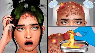 ASMR Head Acne Removal and Pimples Popping  Itchy Scalp Treatment ASMR [upl. by Artapoelc]