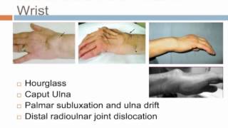 Rheumatoid Wrist by Dr Marc Friso [upl. by Braden47]