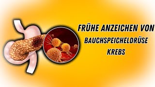 Frühe Anzeichen von Bauchspeicheldrüsenkrebs über die Sie Bescheid wissen müssen [upl. by Wanfried208]