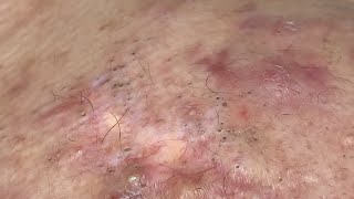 inflamed neck blackheads and whiteheads  dermacool 0187 [upl. by Aikemot]