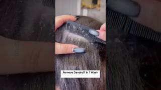 Remove Dandruff in Just 1 Wash  Dandruff Removal Home Remedy shorts dandruff haircare [upl. by Eward302]