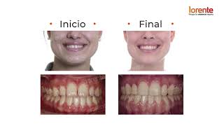 Caso clínico Clase III Dentaria  Lorente Ortodoncia ortodoncia [upl. by Daisi]