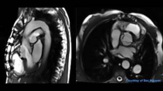 Aortic valve stenosis and regurgitation  Siemens 15T AERA [upl. by Gazo]