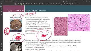 68 Renal Oncocytoma [upl. by Ecinahs461]