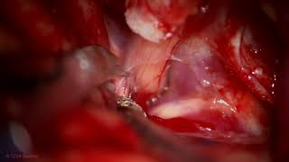 Pterional Craniotomy with Intradural Anterior Clinoidectomy for Clipping of an OphA Aneurysm [upl. by Elorac]