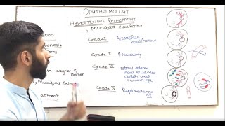 OPHTHALMOLOGY  HYPERTENSIVE RETINOPATHY [upl. by Mcallister663]