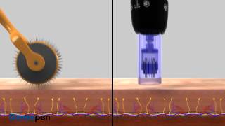 MicroNeedling Procedure Video by Dermapen® [upl. by Esemaj]