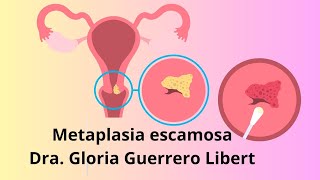 Metaplasia Escamosa en mi papanicolaou ¿Que hacer [upl. by Fisk]